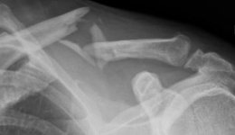 Clavicle2.JPG Clavicle2.JPG