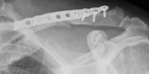 Clavicle3Plate.JPG Clavicle3Plate.JPG