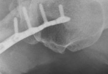 Clavicle4Screw.JPG Clavicle4Screw.JPG
