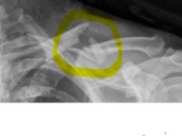 ClavicleHilite.jpg